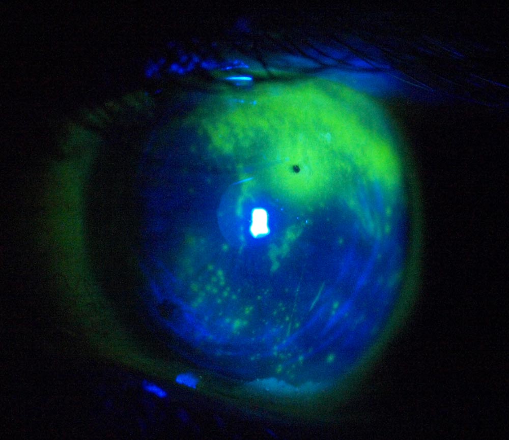 Eye_GA201093.jpg - The eye with flourescein staining showing various corneal lesions (in green) from blue light from a slit lamp. Hand held E510 at 1600 ISO, f/5.6, 1/30thsec IS on, MF.