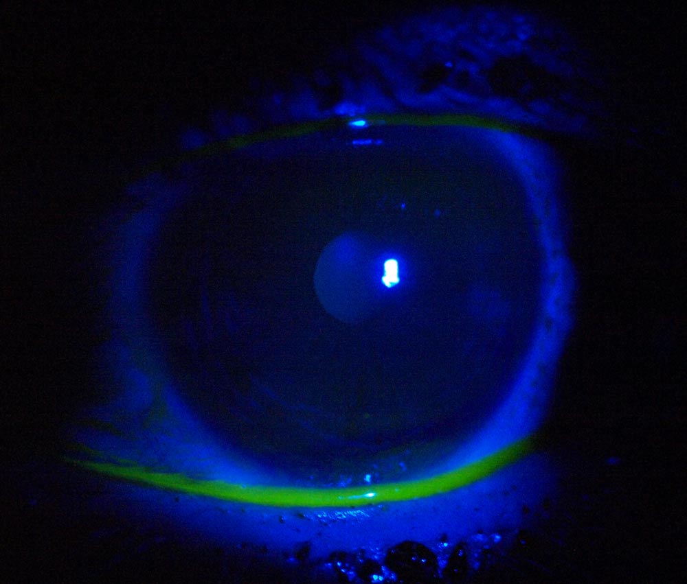 Eye_GA201094.jpg - The eye with flourescein staining showing normal cornea (no green lesions - green at base is just pooled stain) from blue light from a slit lamp. Hand held E510 at 1600 ISO, f/5.6, 1/30thsec IS on, MF.